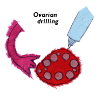 Laparoscopic Ovarian Drilling