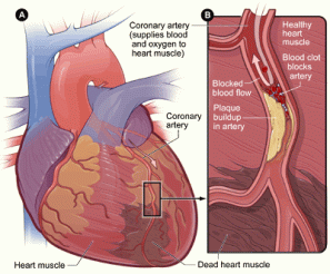 heart_coronary_artery1